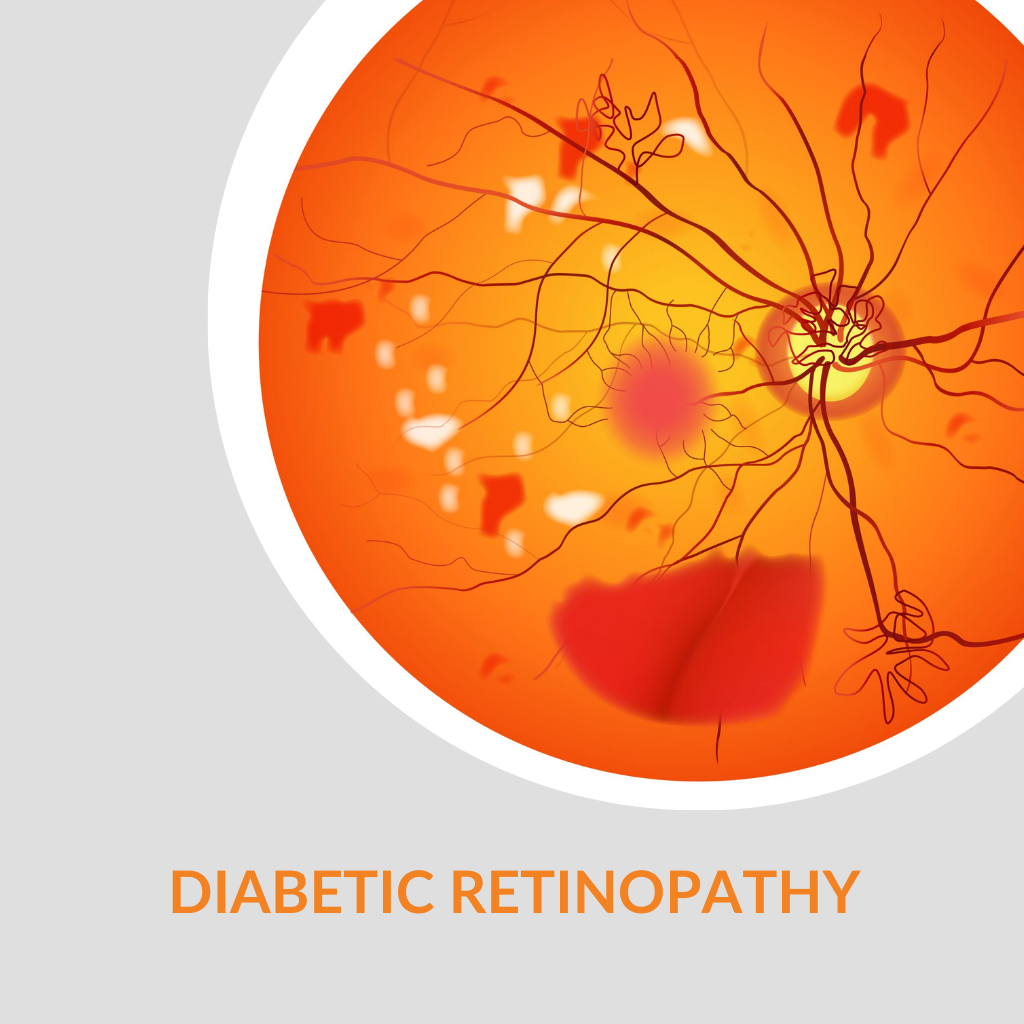diabetic-retitinopathy-diesease